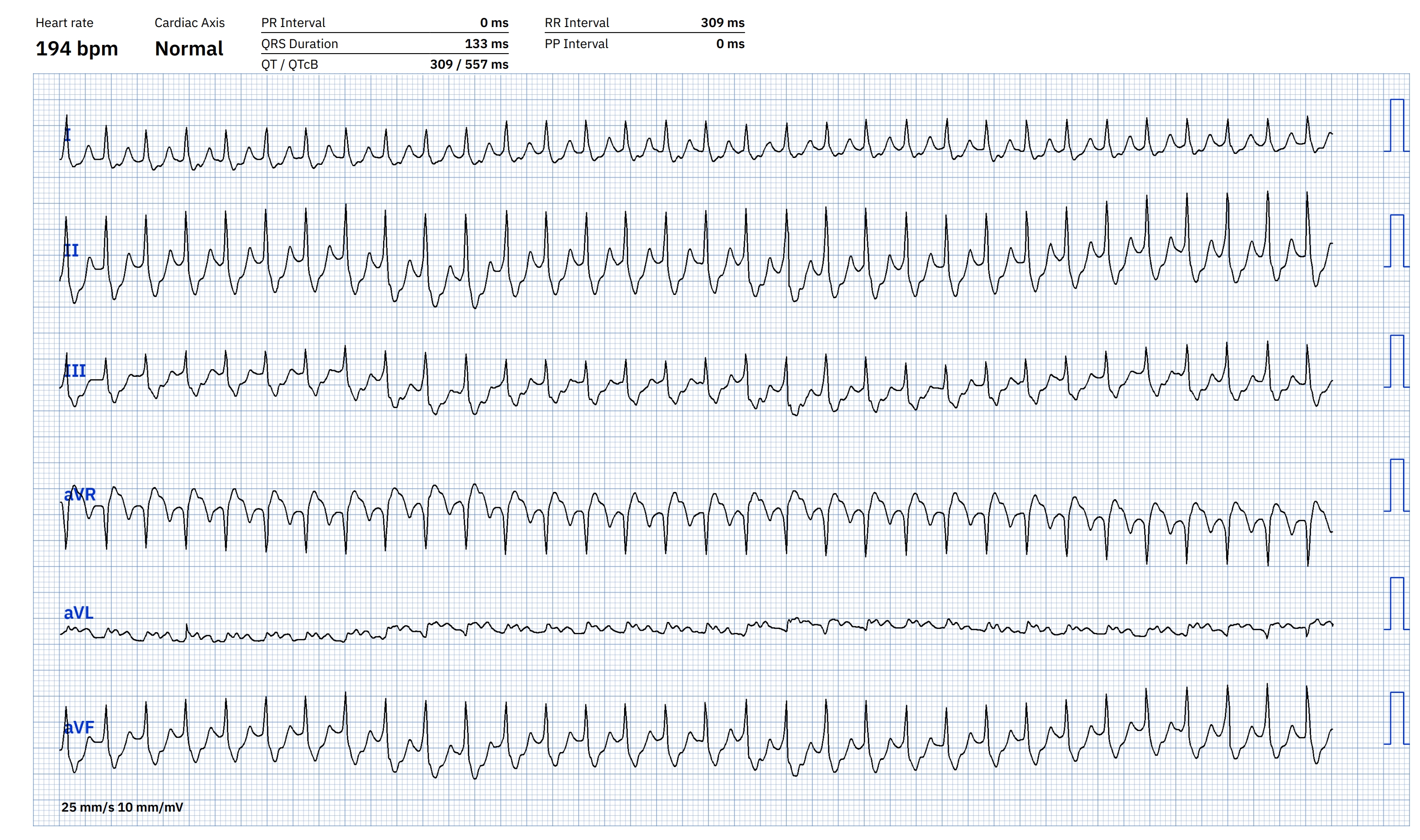 V tach outlet vs supraventricular tachycardia